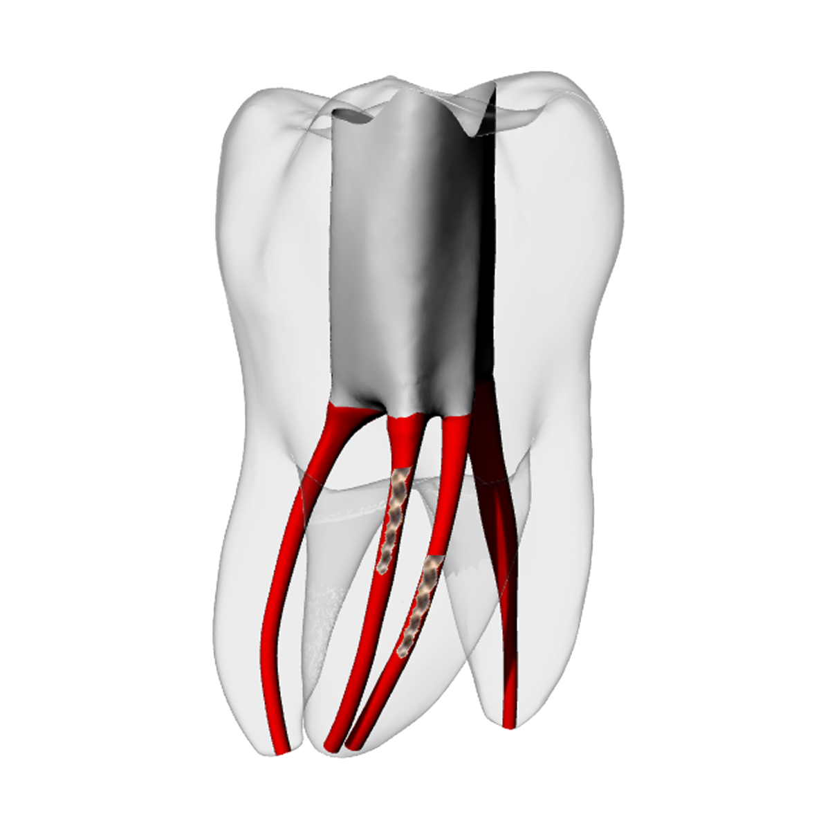 Molar – Two Broken files | Dental Training Models | DRSK – DRSK Group AB, Accessories for Root Canal Treatment
