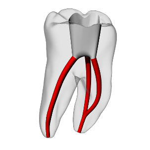 Molar – Accessed, Merging canals, Clear | Dental Training Models | DRSK – DRSK Group AB