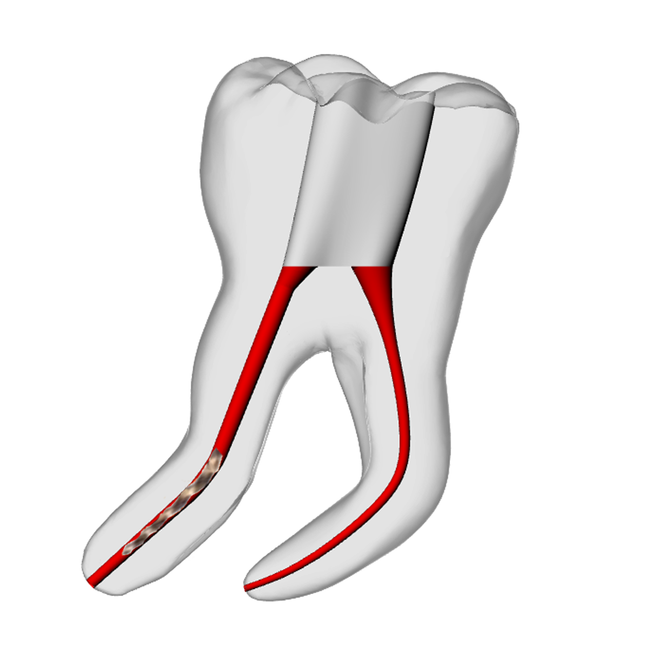 Molar – 6mm Broken File, 30° Distal Canal | Dental Training Models | DRSK