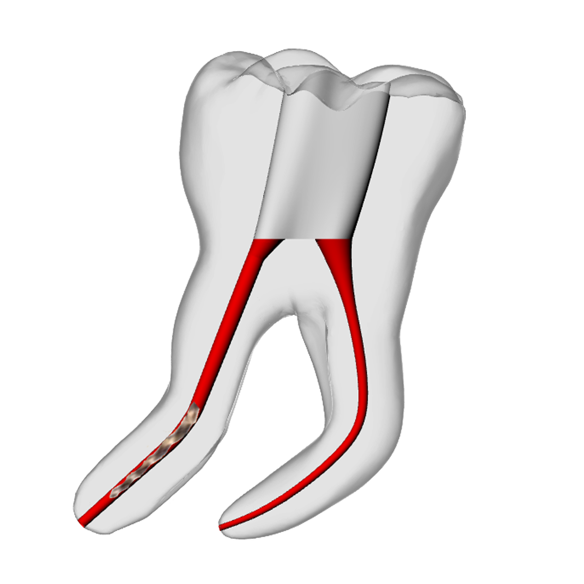 Molar – 6mm Broken File, 30° Distal Canal | Dental Training Models | DRSK – DRSK Group AB, Zubehör für Wurzelbehandlung