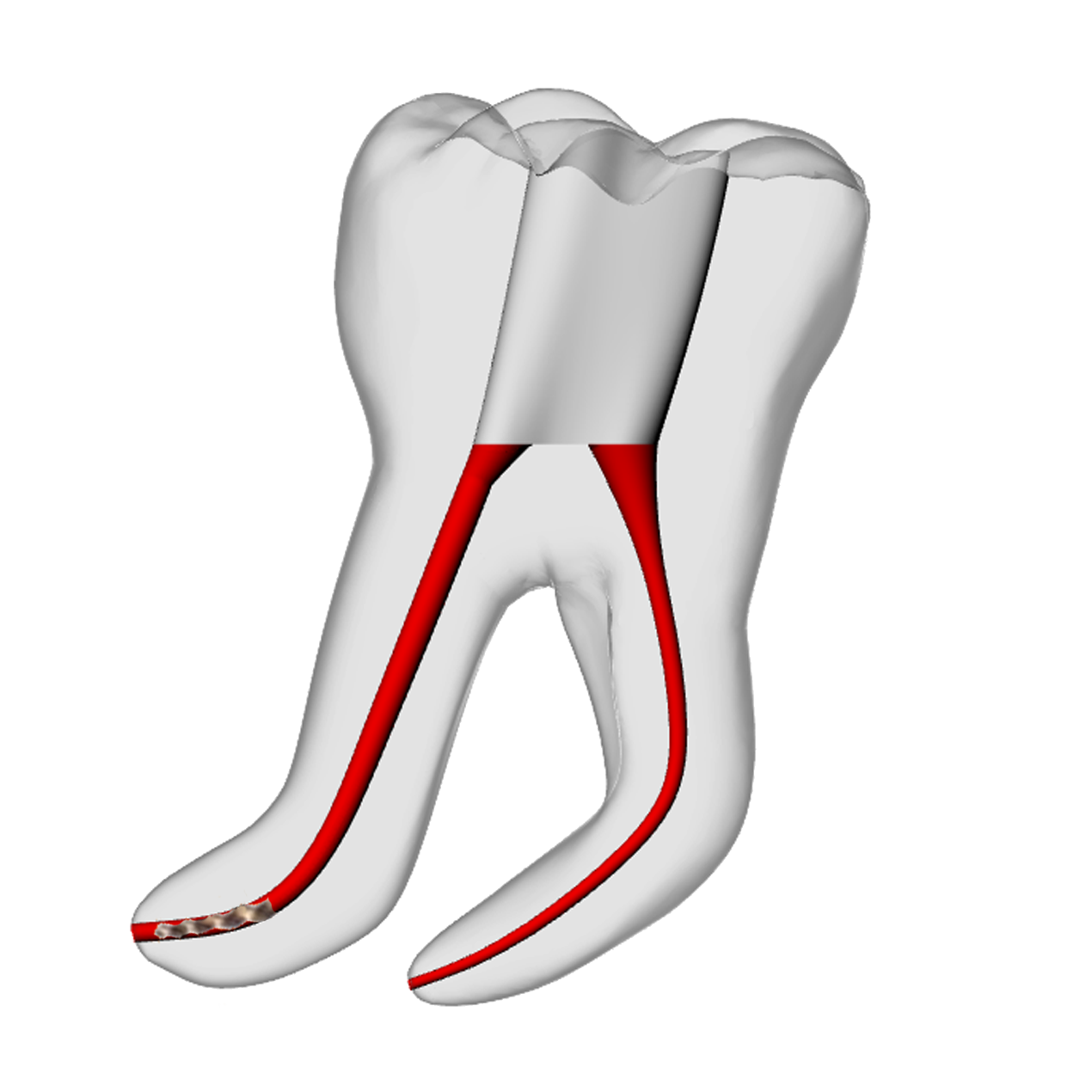 Molar – 3mm Broken File, 60° Distal Canal | Dental Training Models | DRSK