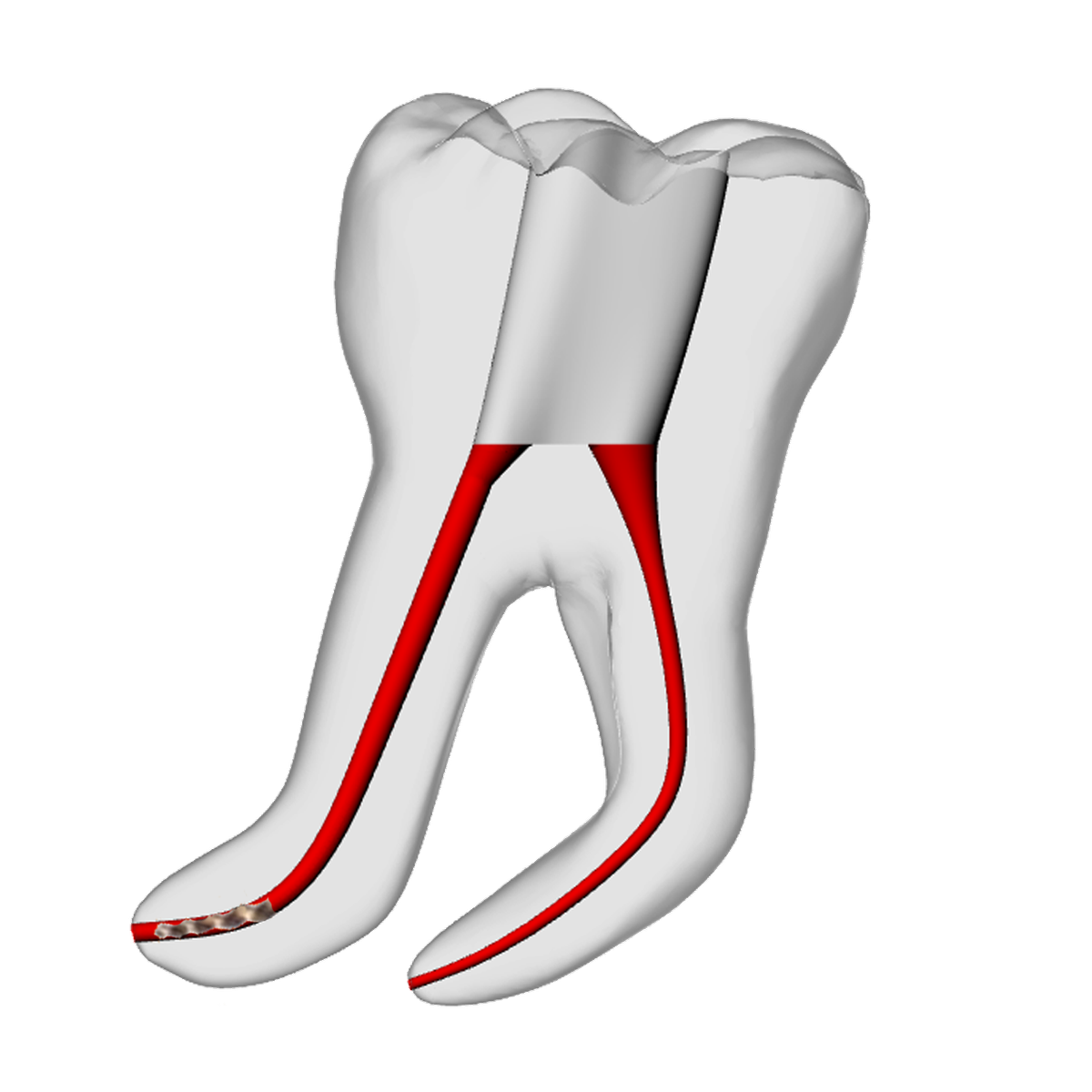 Molar – 3mm Broken File, 60° Distal Canal | Dental Training Models | DRSK – DRSK Group AB, Zubehör für Wurzelbehandlung
