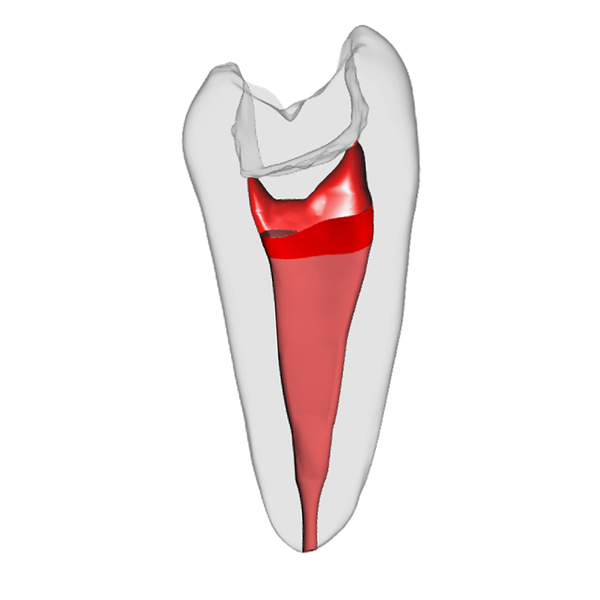 Prämolar - Vitalpulpatherapie, Weiß