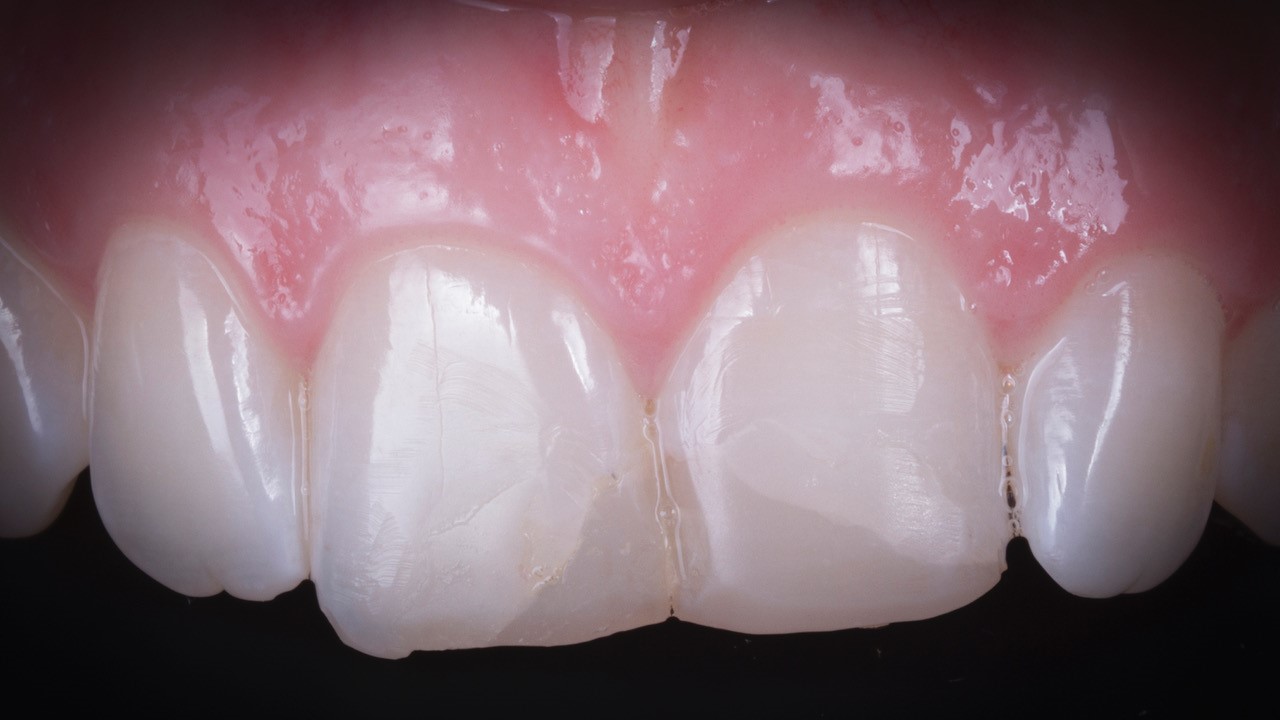 SEALTEMP S Clear – ELSODENT SAS, Crown & Bridge Cements
