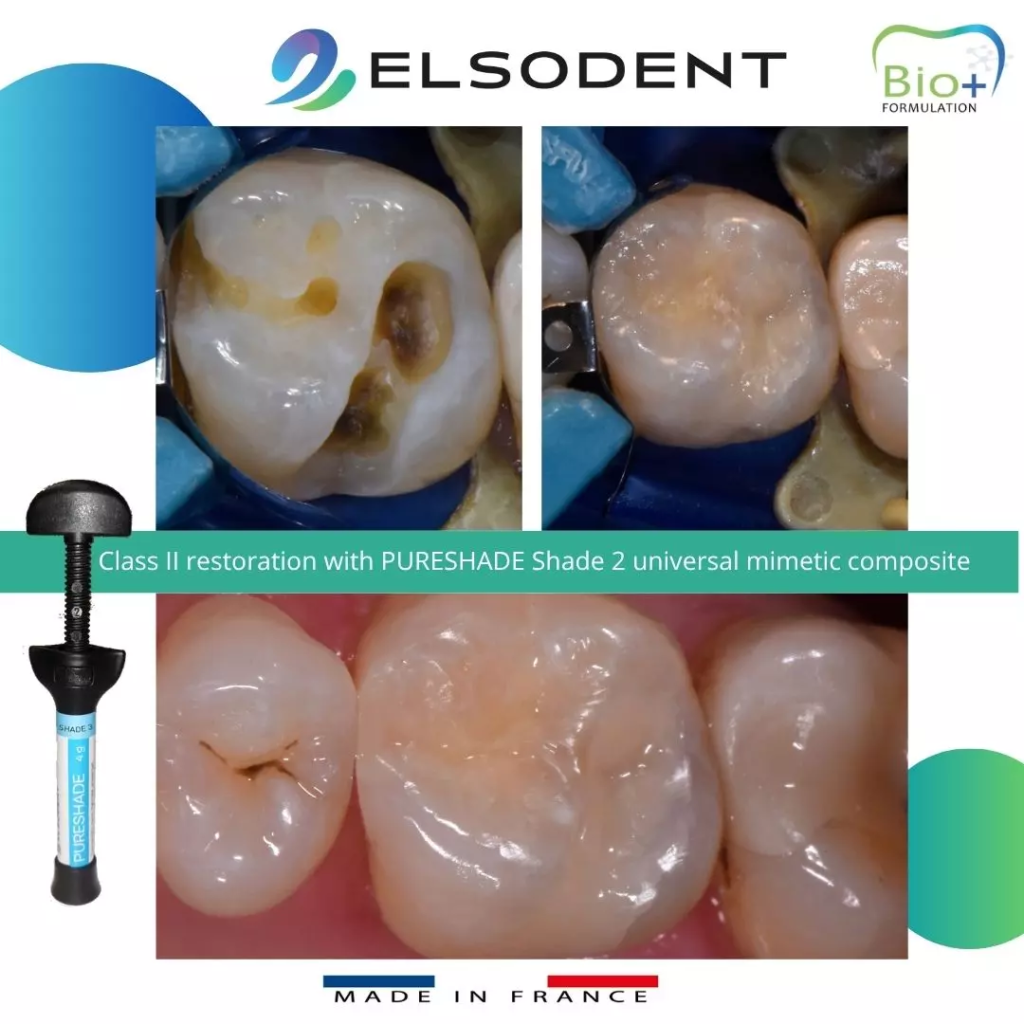 PURESHADE – ELSODENT SAS, Dental Composites