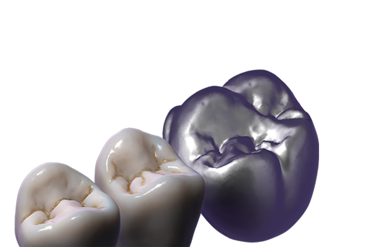 TruSmile™ Module – Exocad, CAD/CAM-Software