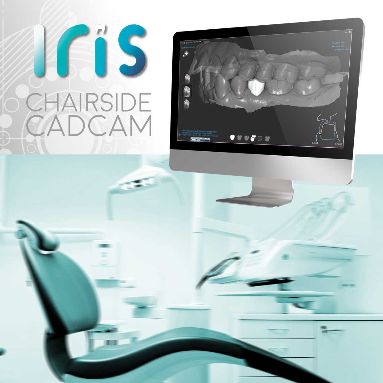 Iris Chairside CADCAM – GO2cam International, CAD/CAM Software