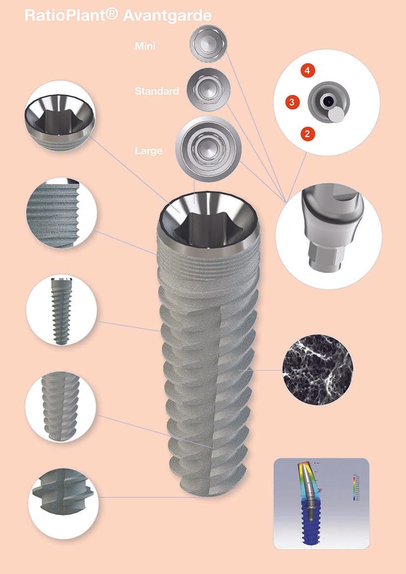 RatioPlant® Avantgarde – HumanTech Dental GmbH, Implants