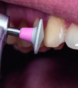 Pinky Highshine Polishing 803 204 304 495 100