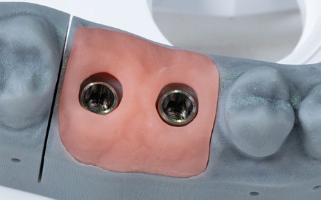 Modellsystem 2000 EvoPrint Starterset – Baumann Dental, Gipszusätze, Stumpflacke und Gipslöser