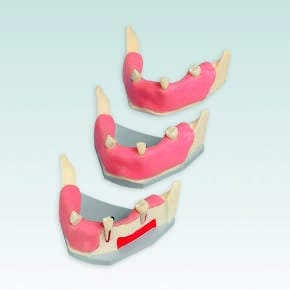 Implantat-Unterkiefer mit weicher Zahnfleischauflage – Frasaco, Equipment