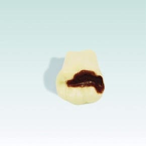 ANA-4 OL46 99-029 Onlay aus frasaco-Zahnmaterial