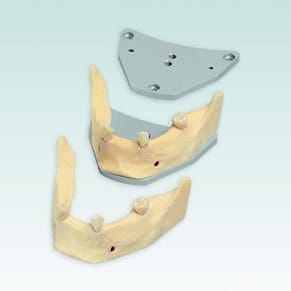 A-J F UK Implantat-Modell Unterkiefer