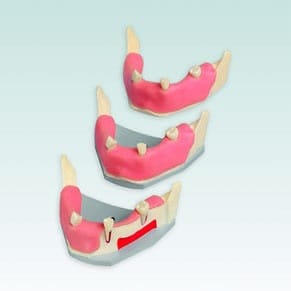 A-J F UKWA Implantat-Modell Unterkiefer mit Weichgewebe und Nerv