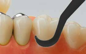 Miraclean-Implant Schwarz Set – Hager & Werken, Periodontal Instruments