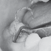 S6 Gingival Cord Packer (#41) – Hu-Friedy Mfg., Matrix Retainers & Wedges
