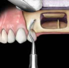 6 Gardner Knochenmeißel, 4 mm – Hu-Friedy Mfg., Bone Rongeurs & Chisels