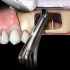 1 Pince Gouge Hu-Friedy, 16,5 cm