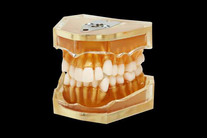 Dental Model for Teeth Extraction