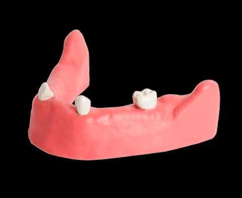 Teilbezahnte Modelle für Implantat-Übungen – Navadha Enterprises, Geräte