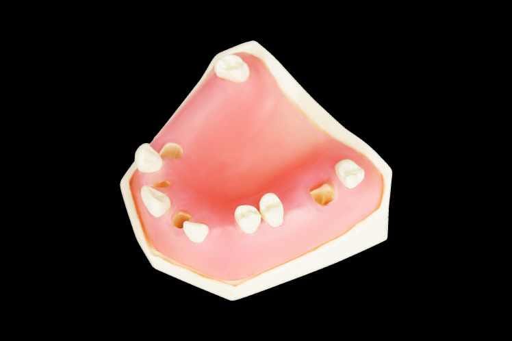 Post Extraction Implant Placement Practise Model – Navadha Enterprises, Equipment