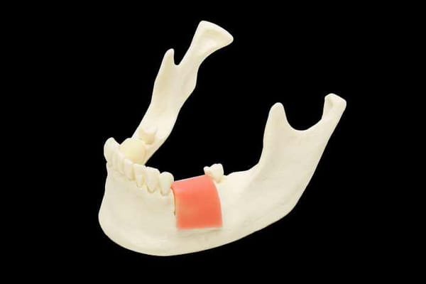 Modell für Implantatinsertion mit auswechselbaren Knochenblöcken unterschiedlicher Knochendichte