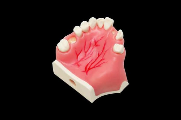 Modell für Implantatinsertion mit Sinussepten