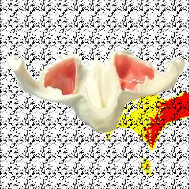 Mâchoire anatomique grandeur nature avec sinus pour implants zygomatiques