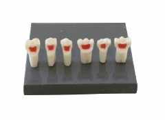 Pulpectomy Teeth for Primary Dentition Model