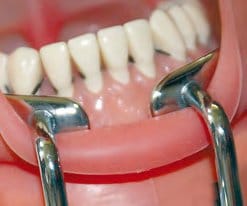 SCHAEFER Wound/Cheek Retractor