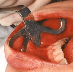 MATY Retraktor – Schwert, Chirurgische Instrumente