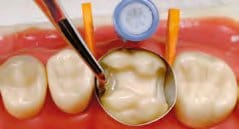 Temporary Crown Remover (COLOR CODE) – Schwert, Provisorische Kronen