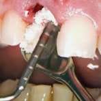 Graft and Sinus Packer (COLOR CODE)