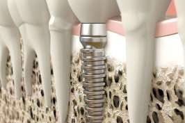 Couteau à gingivectomie KIRKLAND – Schwert, Periodontal Surgery