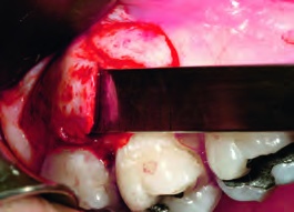 IDR Kit – Schwert, Implant Surgical Kits