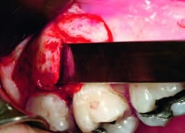 IDR Kit - Immediate Dentoalveolar Restoration
