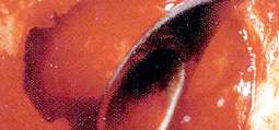 Sinus Lift Curette Standard FIG. 3