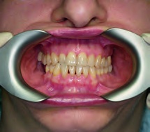 Cheek Retractor for Intraoral Photography, 1/2 Right Sided (Black)