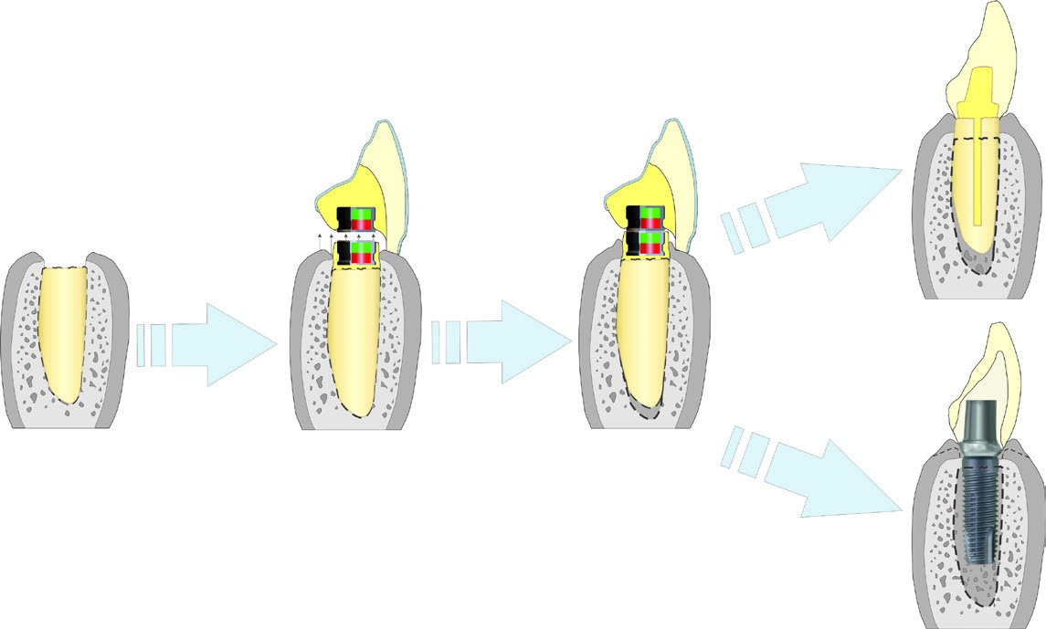 Kit d'aimants d'extrusion – steco-system-technik GmbH & Co. KG, Implant-related Equipment