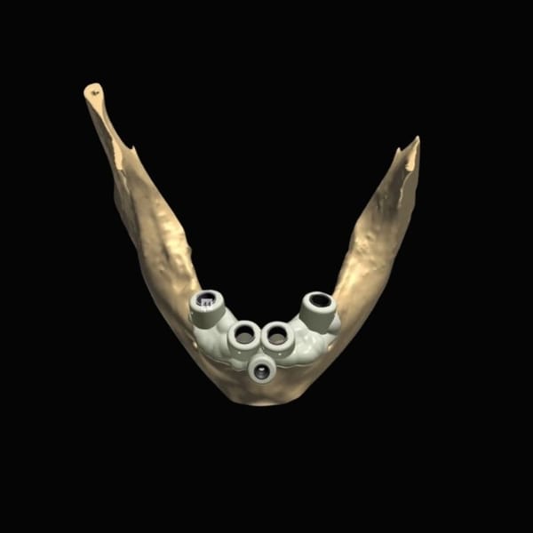 Surgical Guides