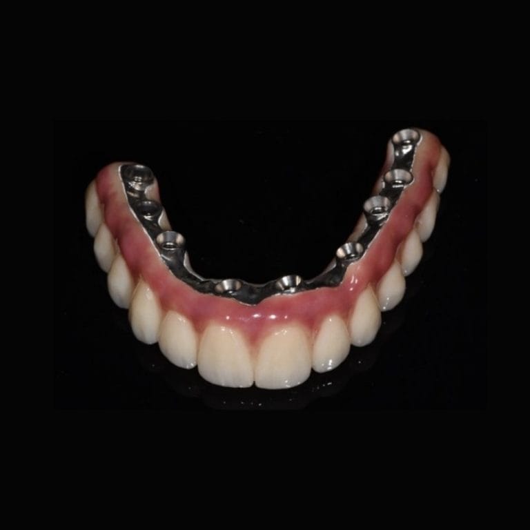 Prisma Bridges – Krausz Dental Lab, Temporary Crowns