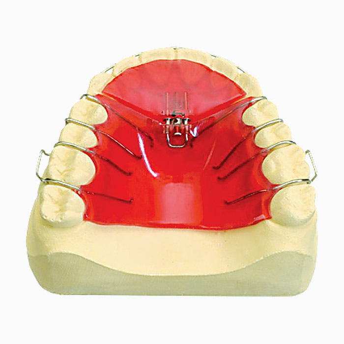 Sagittal Arch Expansion
