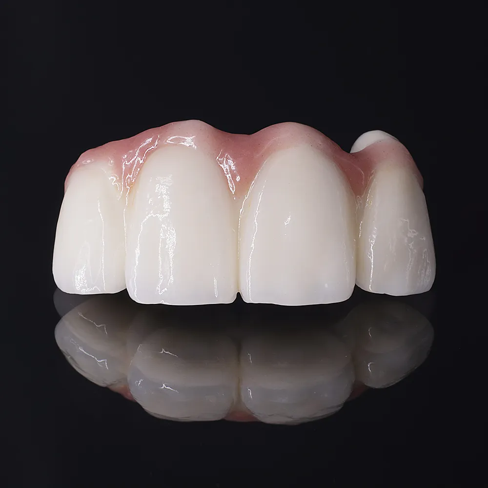 Monolithic Zirconium Crown