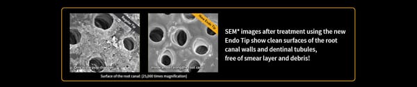 New Endo Tip for LiteTouch™