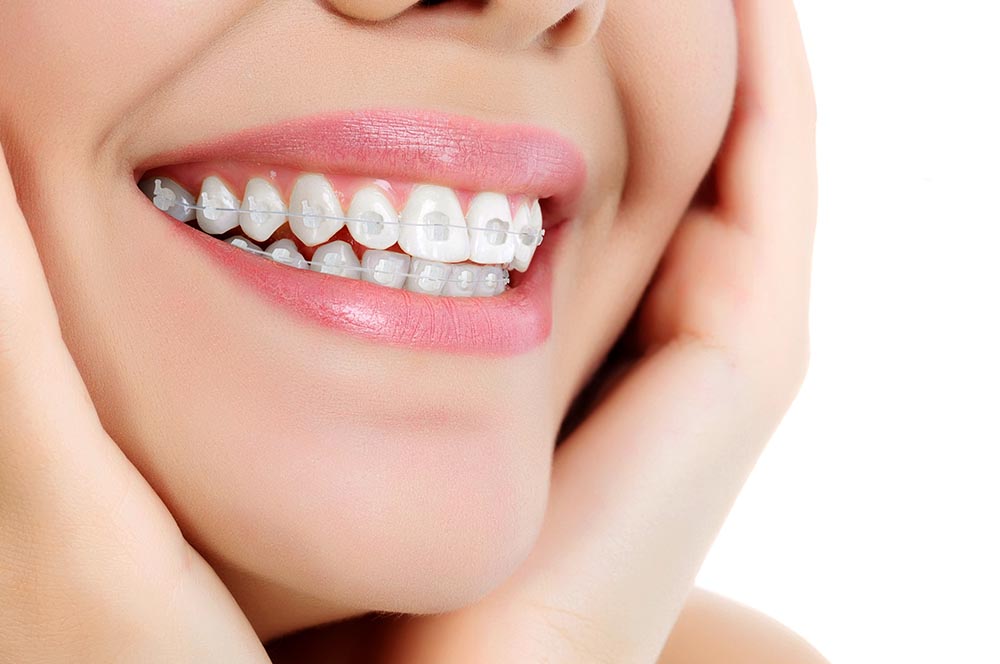 GENIUS CRYSTAL ADVANCED – Ortho Partner, Brackets & Tubes