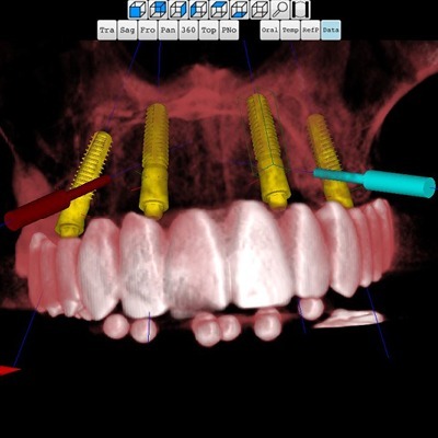 Organical Dental Implant – Organical CAD/CAM, CAD/CAM Software