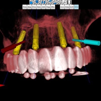 Organical Dental Implant – Organical CAD/CAM, CAD/CAM Software