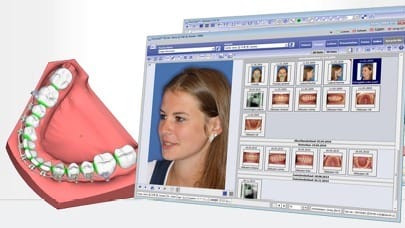 Onyxceph – Organical CAD/CAM, CAD/CAM-Software