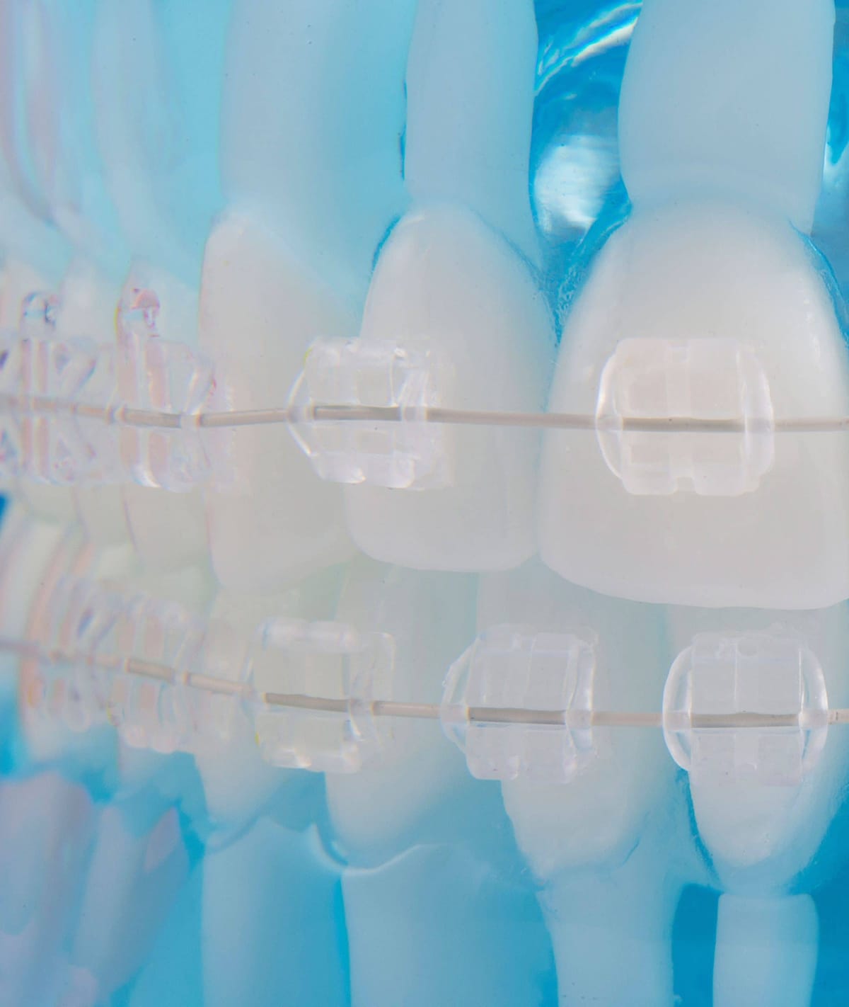 Clear Bracket – Orthobasics GmbH & Co. KG, Brackets