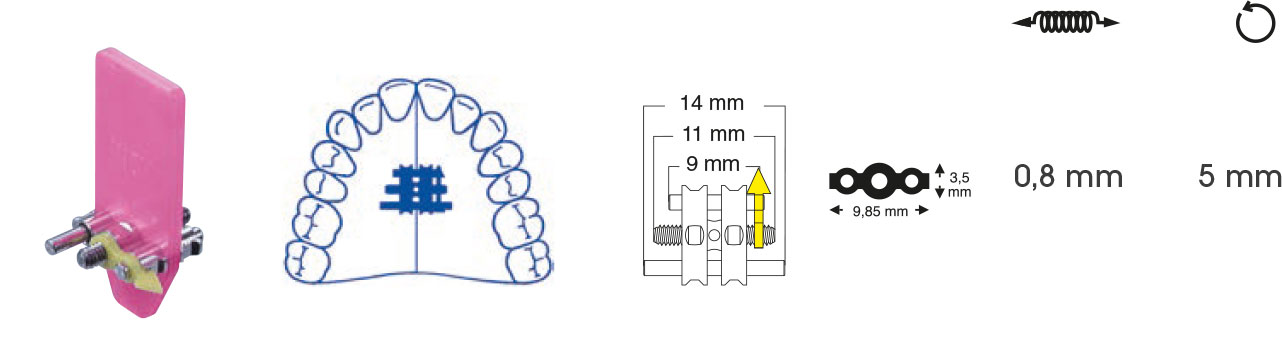 Trapezdehnschraube – Orthobasics GmbH & Co. KG, Intraoral Appliances